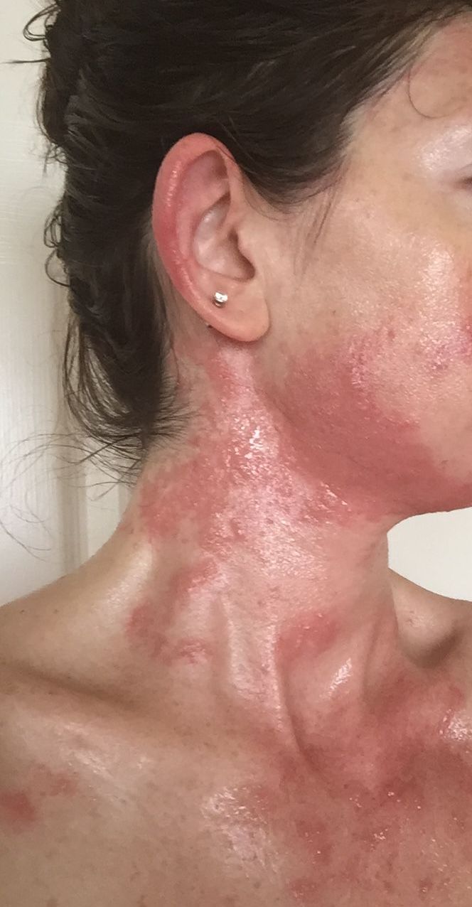 allergic contact dermatitis poison ivy