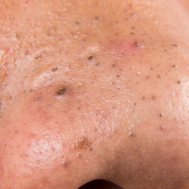 Acne comedones - Arch Dermatology Institute - St. Louis, Missouri