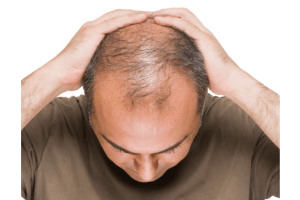 Hair Loss Treatment