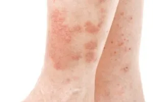 Eczema Treatment in St. Louis