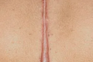 Scars/Keloids treatment