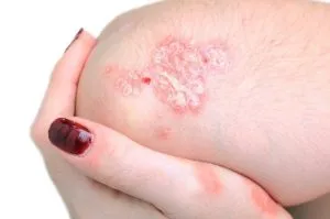 Psoriasis Treatment