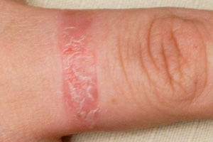 Contact Dermatitis