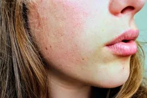 Rosacea Treatment