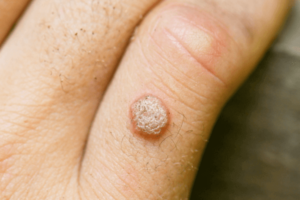 Dermatology Services in St. Louis